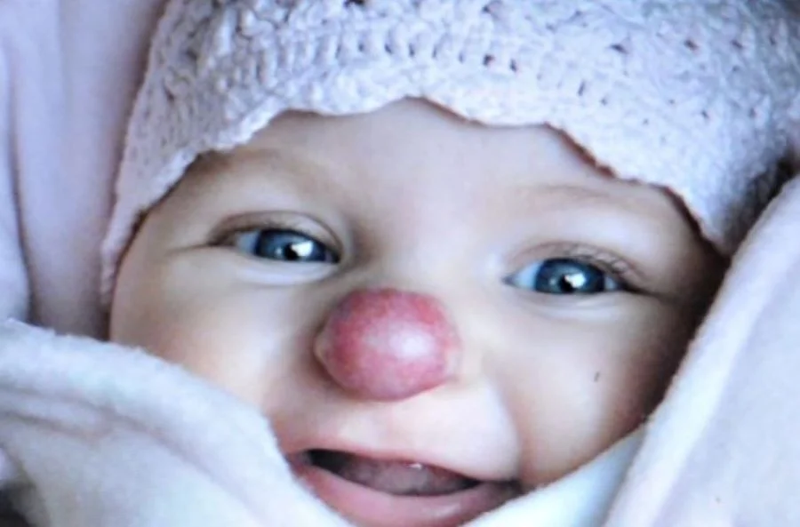 «Девочка с носом клоуна»: история Кони Лойд, которая доказала — испытания не определяют судьбу